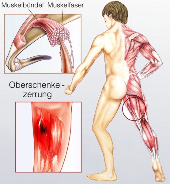 Dauer oberschenkel muskelfaserriss hinterer Muskelriss im